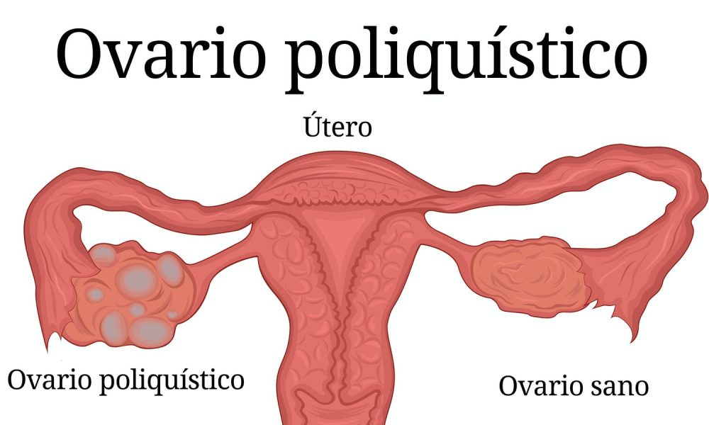 Síndrome de ovarios poliquísticos
