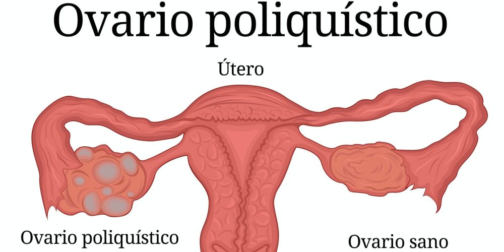 Síndrome de ovarios poliquísticos